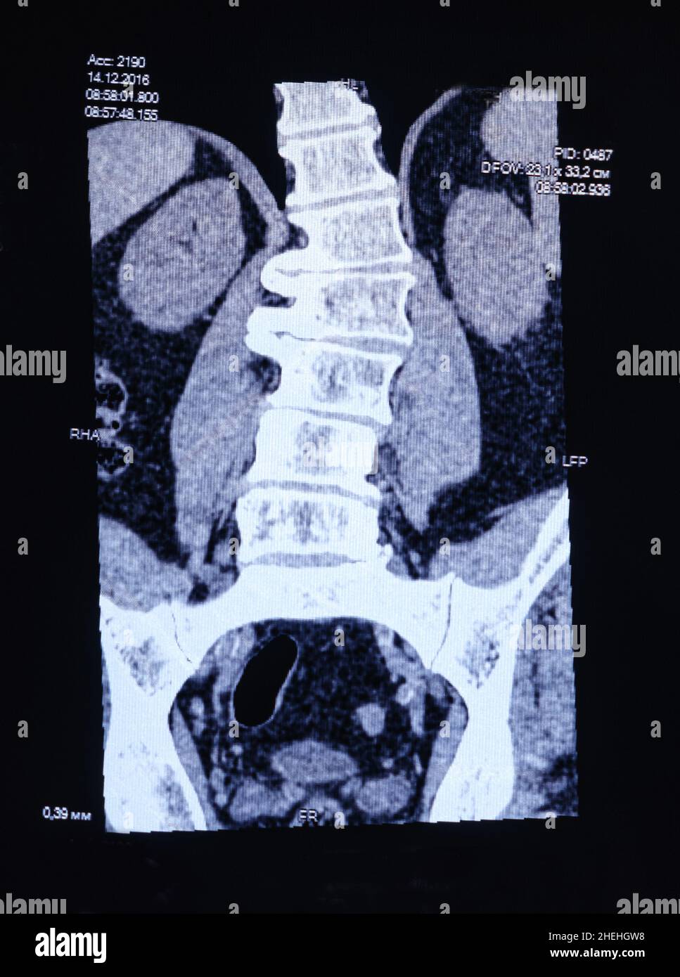 CT-Bild der Wirbelsäule eines Patienten mit Skoliose und Vorwölbung der Bandscheibe. Stockfoto