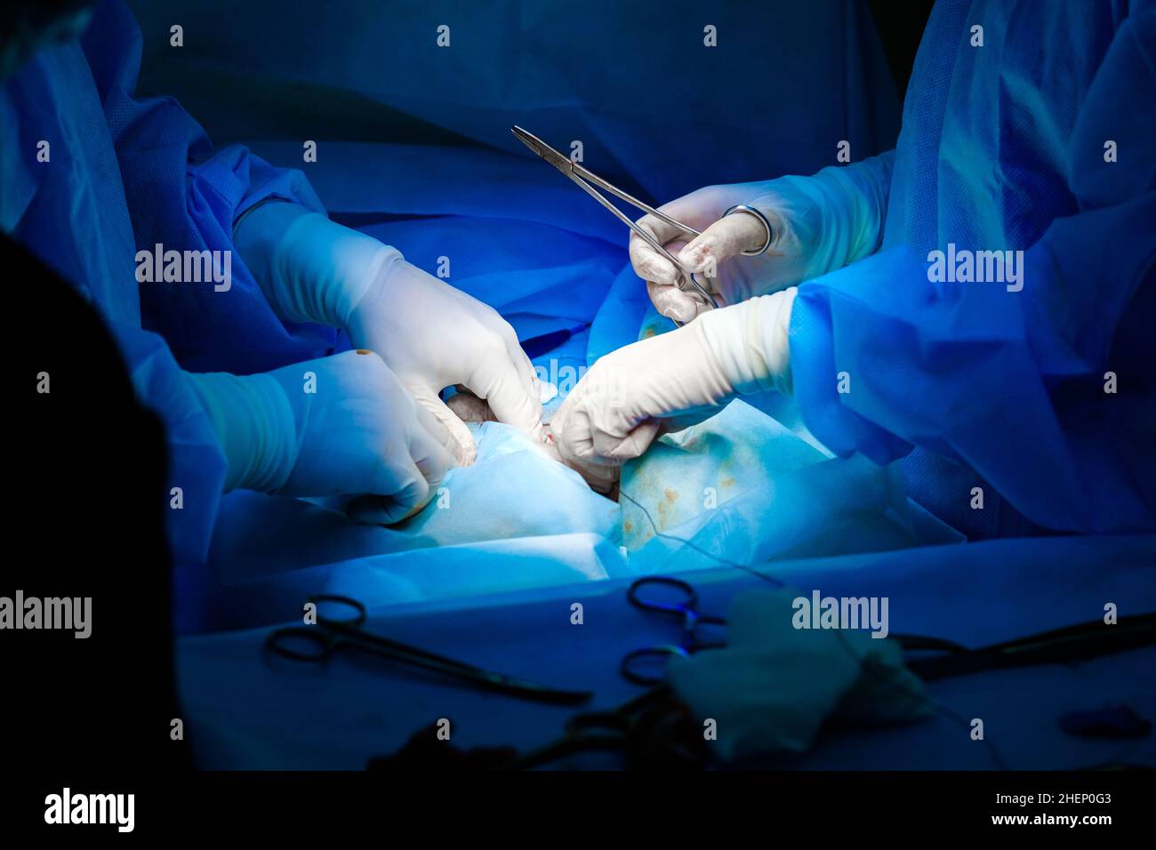 Abdominal Incision Stockfotos und -bilder Kaufen - Alamy