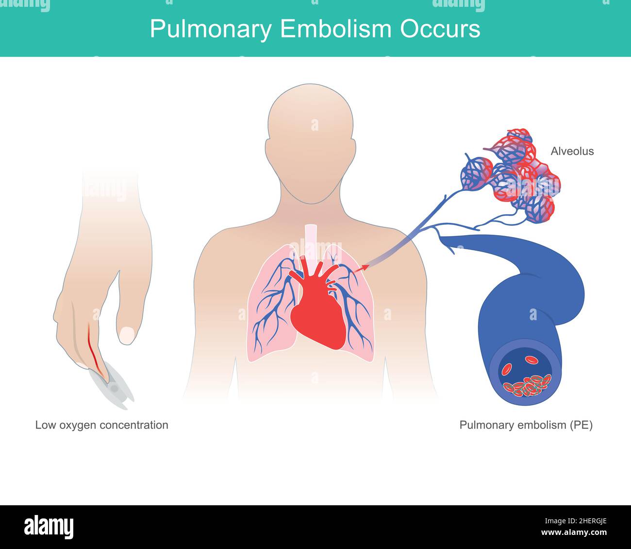 Es Tritt Eine Lungenembolie Auf. Es treten abnorme Zustände von niedrigerem Sauerstoffgehalt im Blut auf, die durch Lungenembolie verursacht werden. Stock Vektor
