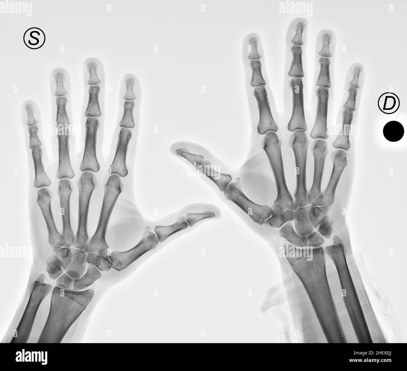 Röntgenaufnahme von Händen mit Arthritis in den Daumen Stockfoto