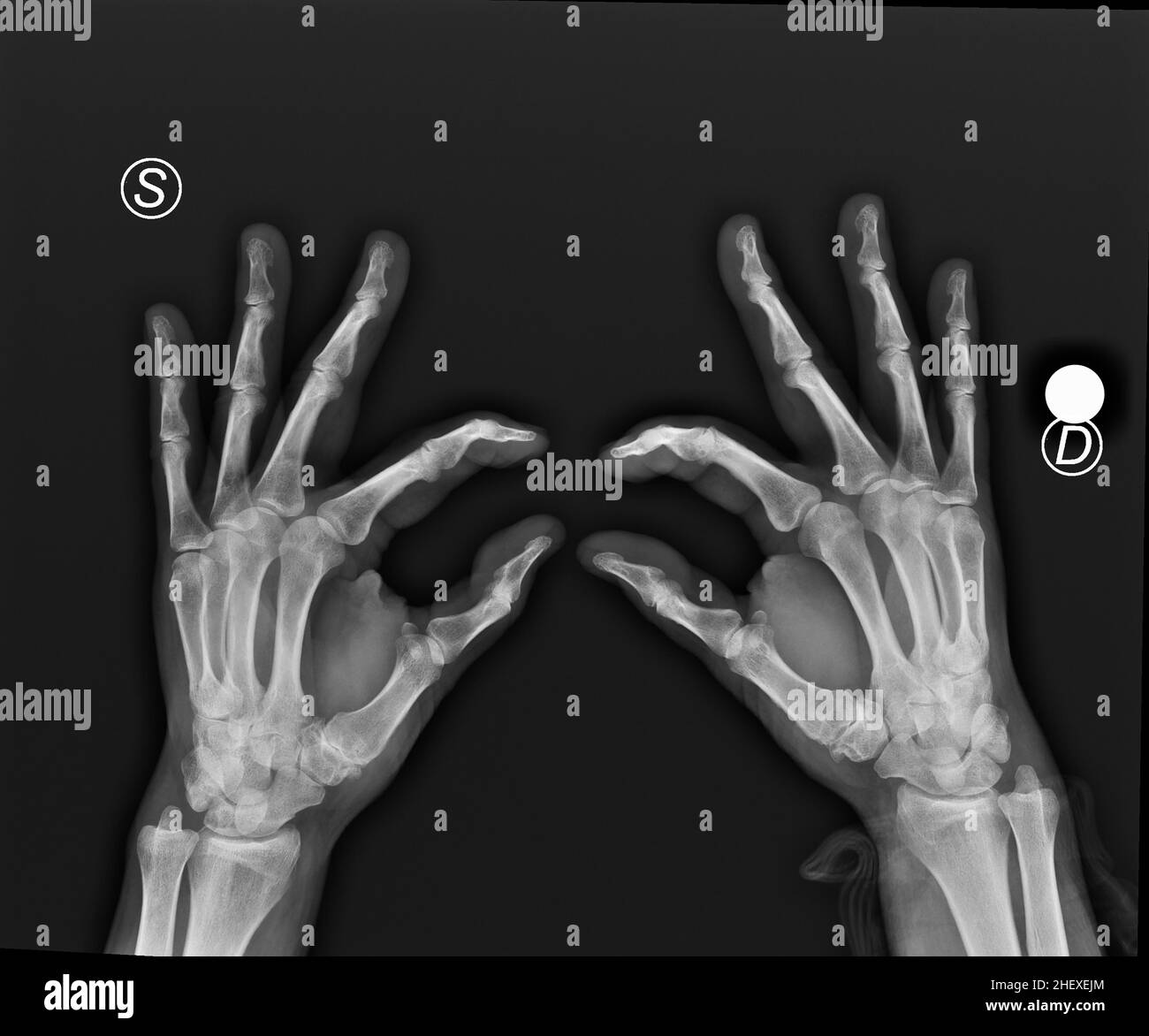 Röntgenaufnahme von Händen mit Arthritis in den Daumen Stockfoto