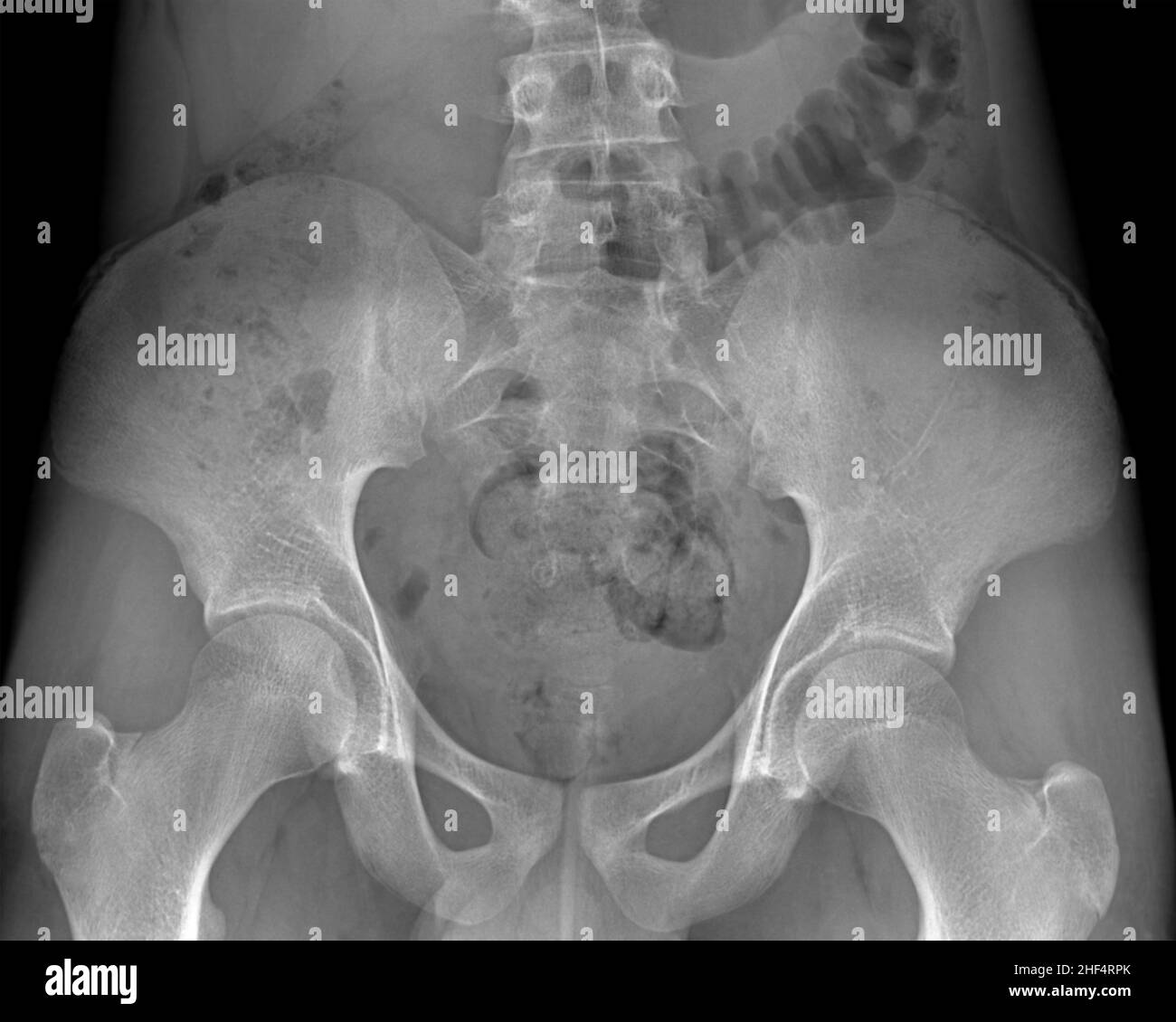 Radiographie des Beckens eines Patienten mit Hüftschmerzen Stockfoto