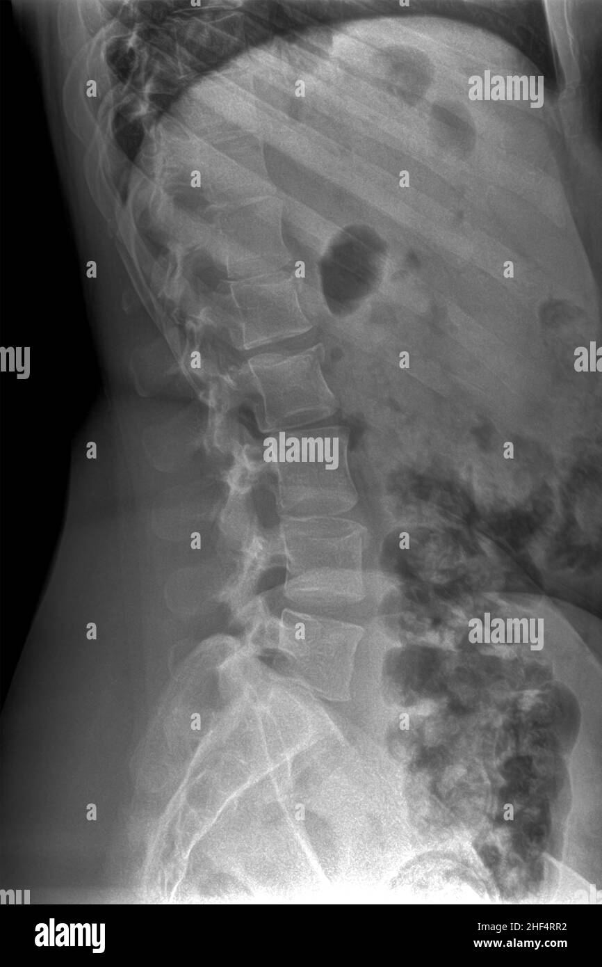 Lumbale Wirbelsäulenradiographie, in lateraler Projektion Stockfoto