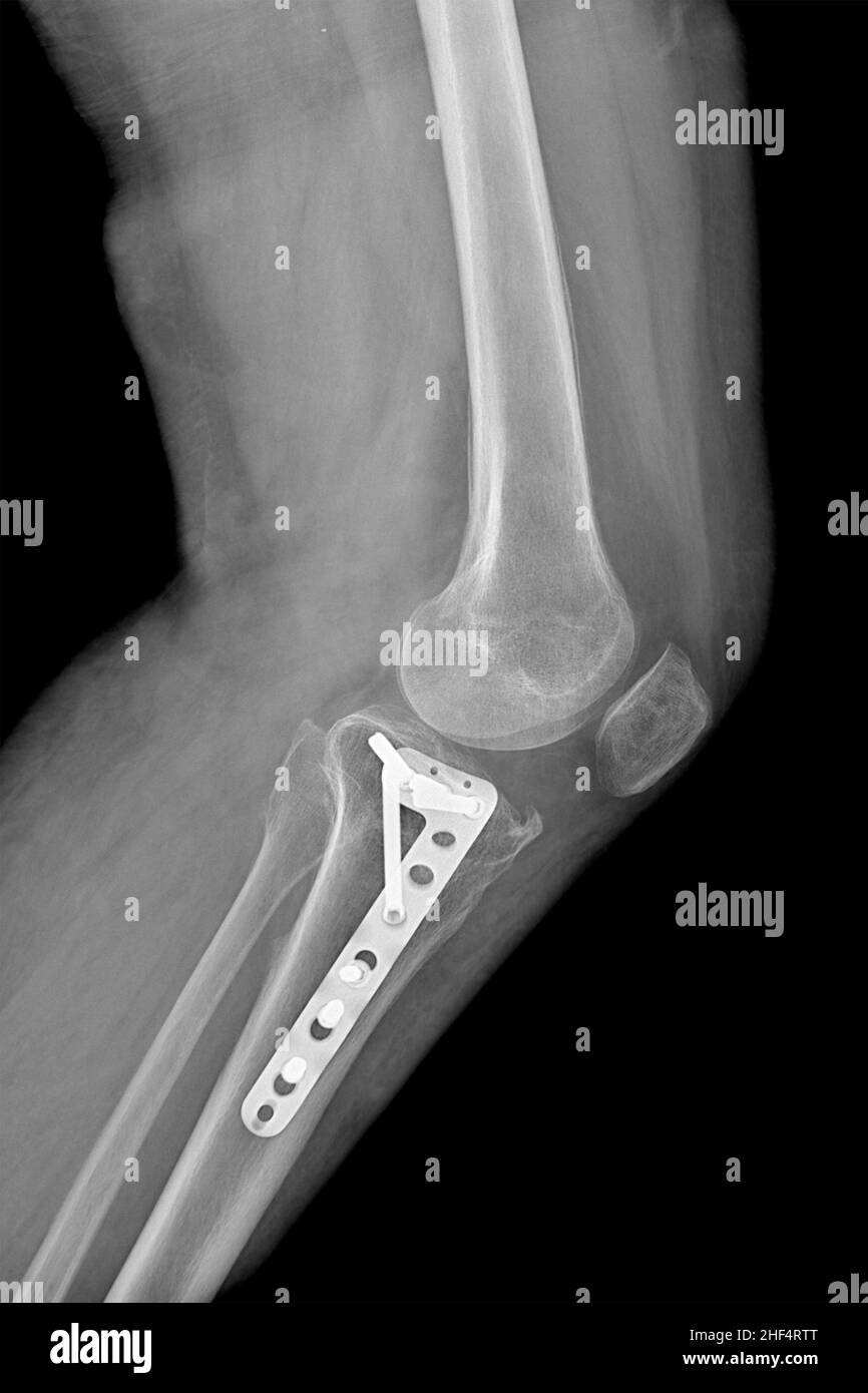 Radiographie des operierten Tibia, in lateraler Projektion, bei einem Patienten nach einem Unfall Stockfoto