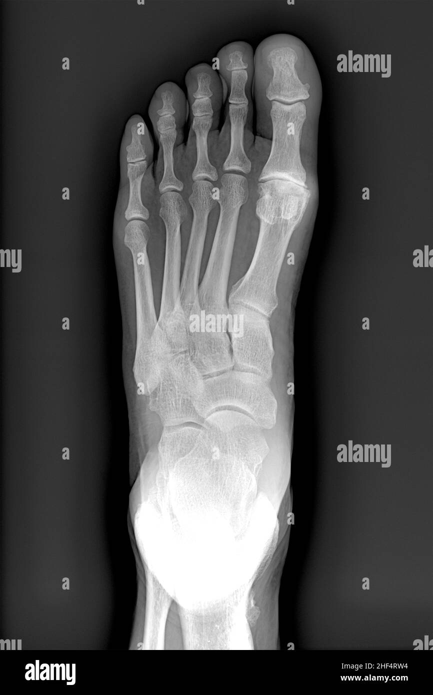 Fußradiographie, bei anterior-posterior Projektion Stockfoto