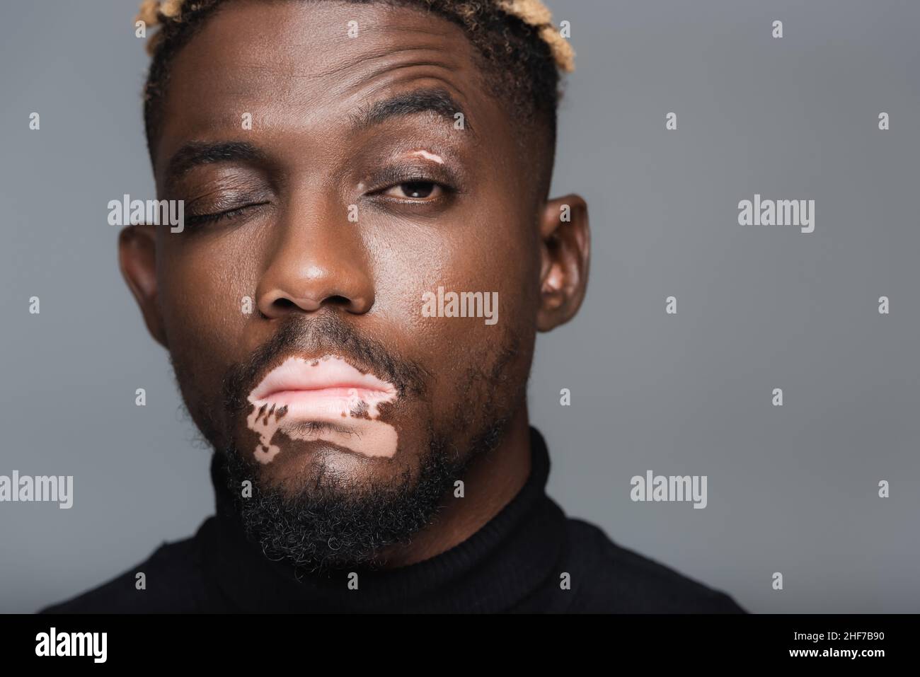 Nahaufnahme eines afroamerikanischen Mannes mit Vitiligo und einem geschlossenen Auge, der die Kamera isoliert auf Grau betrachtet Stockfoto