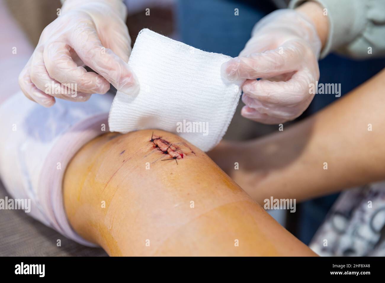 Reinigung und Verband Einschnitt und Stiche nach der Operation Stockfoto