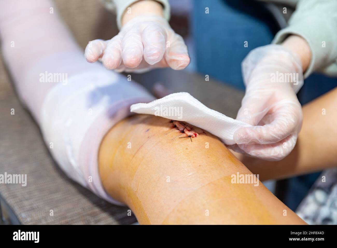 Reinigung und Verband Einschnitt und Stiche nach der Operation Stockfoto
