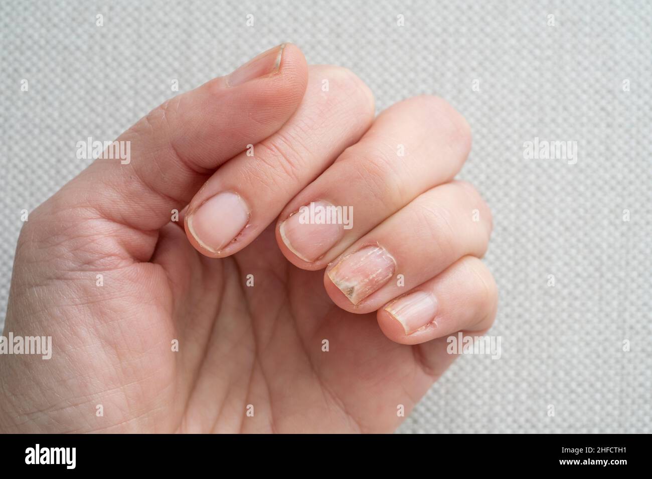 Nagelpilz finger Fotos und Bildmaterial in hoher Auflösung Alamy