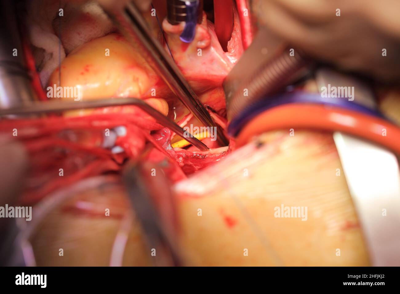 Offenes Herz mit Drainagerohren und Instrumenten in Nahaufnahme während der Operation. Stockfoto