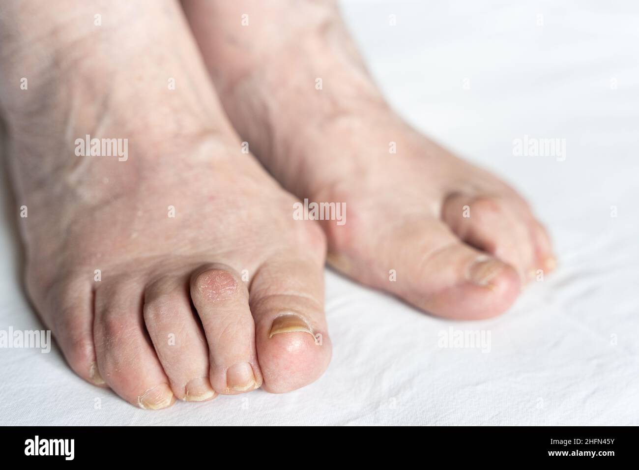 Bunions auf den Füßen einer älteren Frau mit Hammerzehen und trockener Haut auf weißem Hintergrund. Hygiene, Chirurgie, Gesundheitswesen, Podologen, dermatologische Konzepte Stockfoto