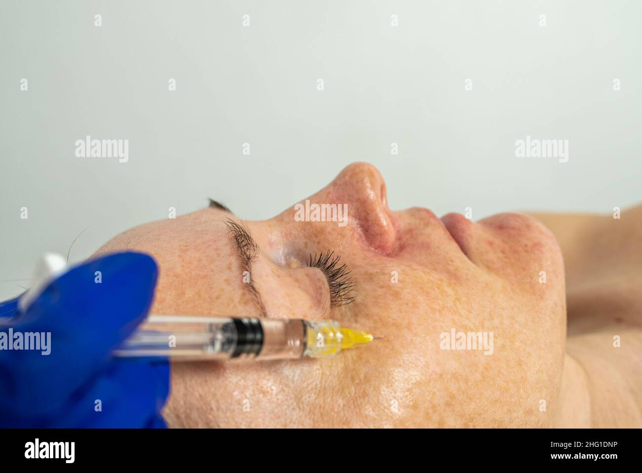 Botulinumtoxin-Injektion auf die Augenpartie, zum Heben der Haut um die Augen, Mesotherapie. Stockfoto