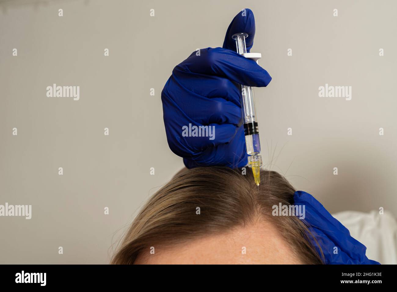 Mesotherapieverfahren. Ein Kosmetologe führt eine Mesotherapie im Kopf einer Frau durch. Stärkung der Haare und ihr Wachstum Stockfoto