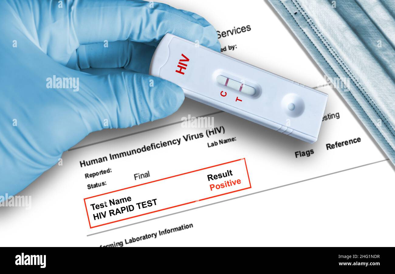 Ergebnis des HIV-positiven Antigentests unter Verwendung eines Schnelltestgeräts, das von Hand in einem medizinischen Handschuh mit medizinischer Gesichtsmaske im Hintergrund gehalten wird. Stockfoto