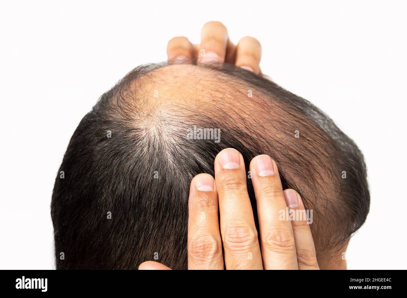 Mann mittleren Alters, der mit Haarausfall befaßt ist. Kahlheit Stockfoto