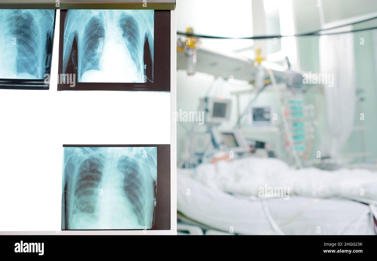Serie von Röntgenbildern des Brustkorbs, die den Zustand des Patienten dynamisch widerspiegeln. Stockfoto