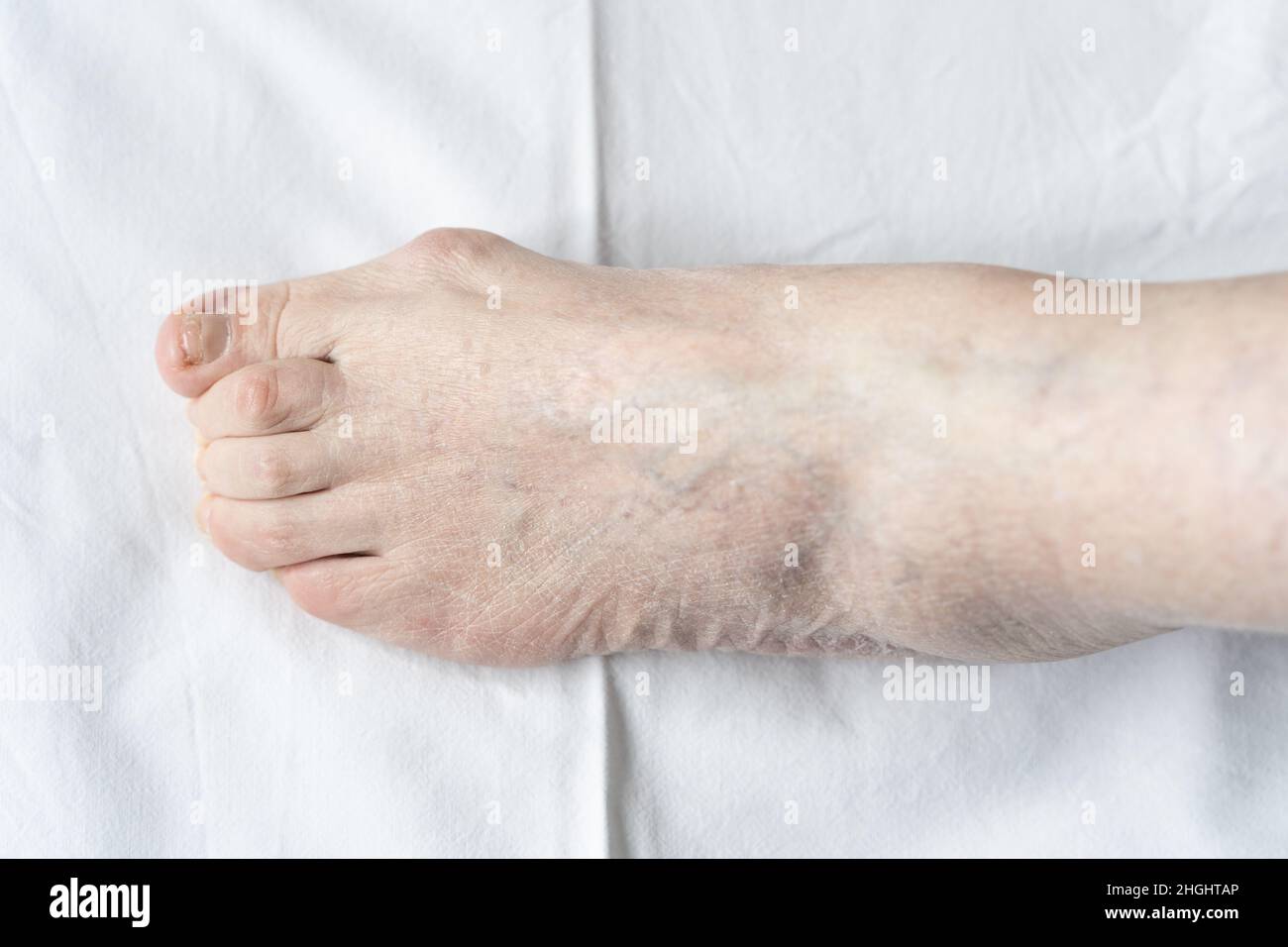 Bunion zu Fuß einer älteren Frau mit Hammerzehe und trockener Haut auf weißem Hintergrund. Hygiene, Chirurgie, Gesundheitswesen, Podologen, dermatologische Konzepte Stockfoto