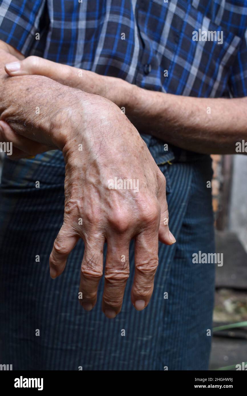 Radiale Nervenverletzung oder Absinken des Handgelenks des älteren Mannes aus Asien. Stockfoto