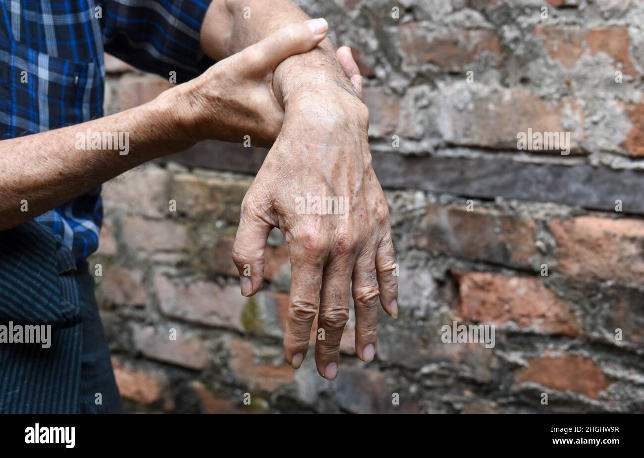 Radiale Nervenverletzung oder Absinken des Handgelenks des älteren Mannes aus Asien. Stockfoto