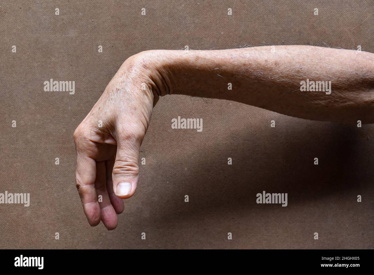 Radiale Nervenverletzung oder Abtropfen des Handgelenks eines alten asiatischen Mannes. Stockfoto