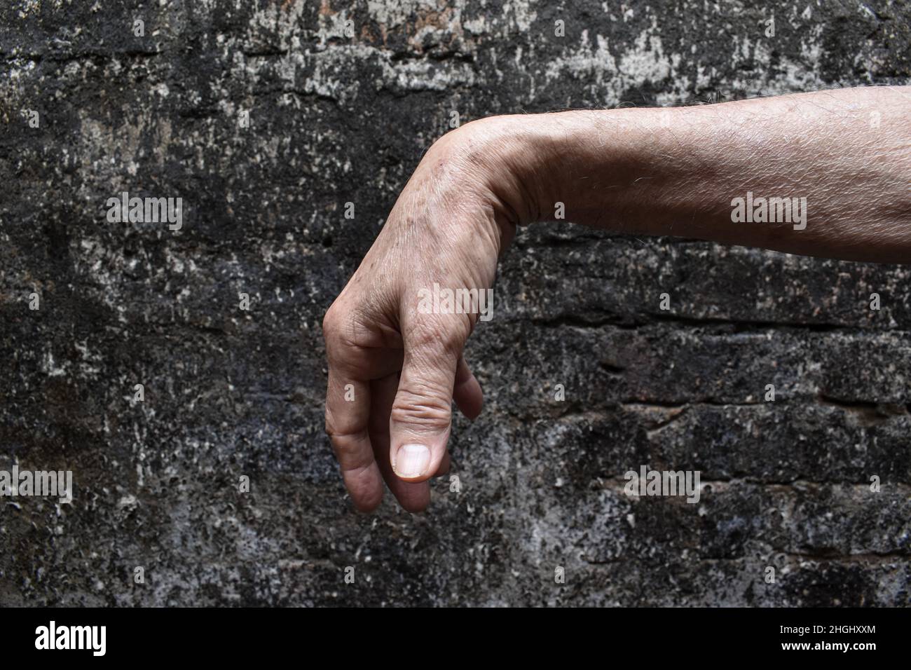 Radiale Nervenverletzung oder Abtropfen des Handgelenks eines alten asiatischen Mannes. Stockfoto