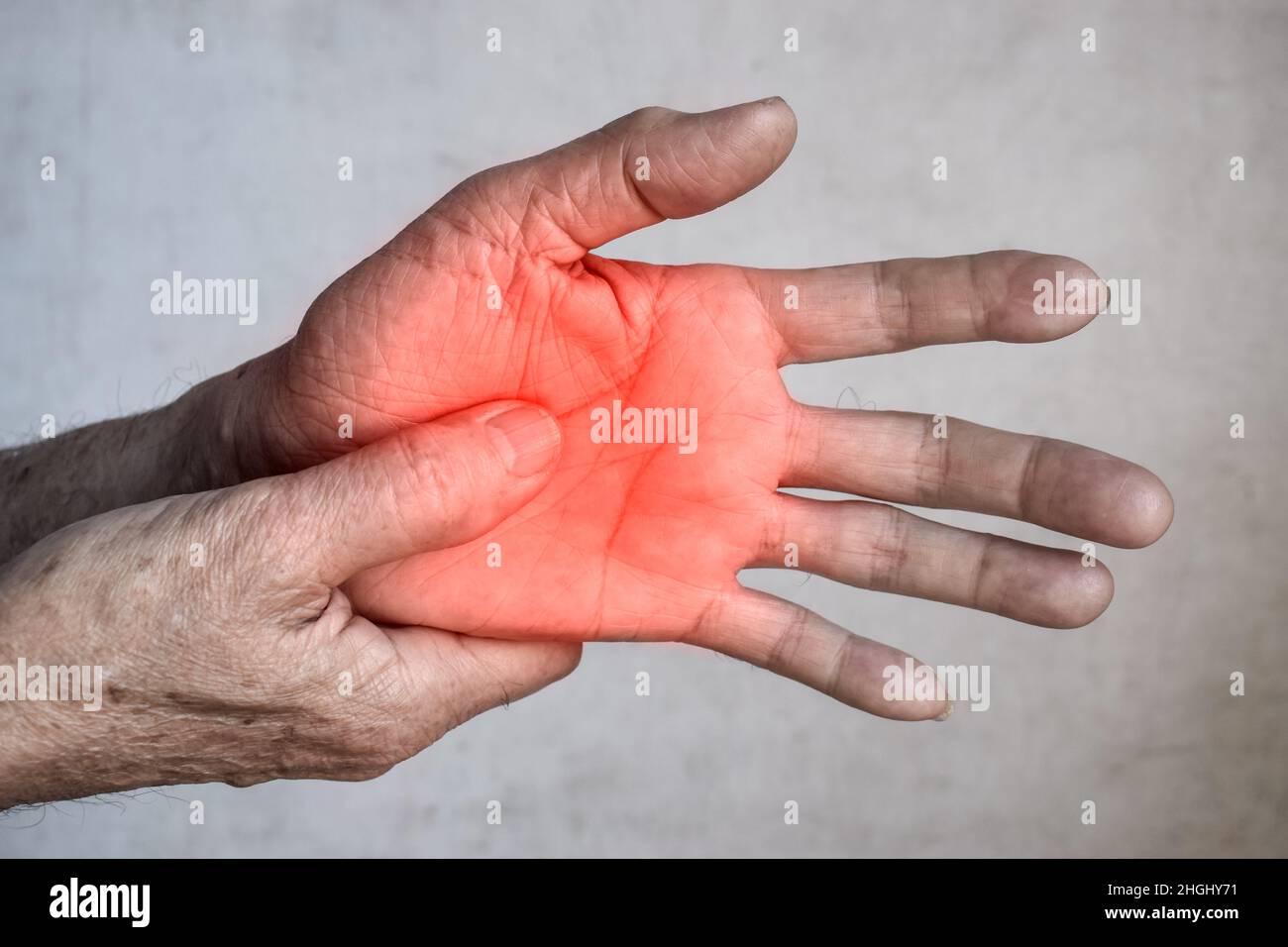 Schmerzhafter Palmaraspekt des asiatischen alten Mannes. Konzept des Kompartiment-Syndroms, Zellulitis und Schmerzen der Handmuskulatur. Stockfoto