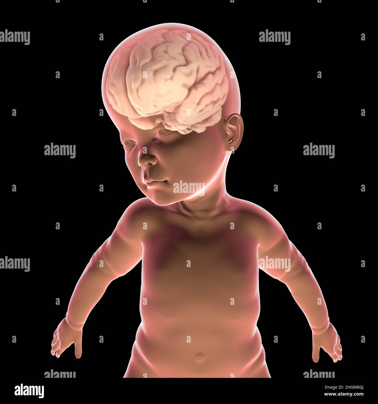 Makrozephalie kapillarfehlbildung Fotos und Bildmaterial in hoher