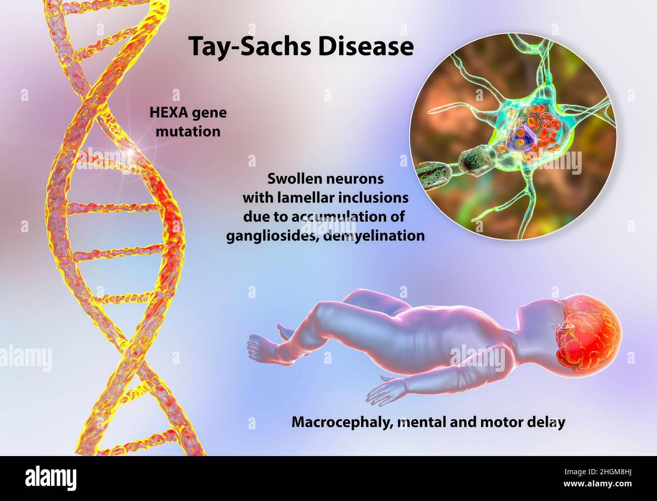 Tay-Sachs-Krankheit, Computerdarstellung Stockfoto