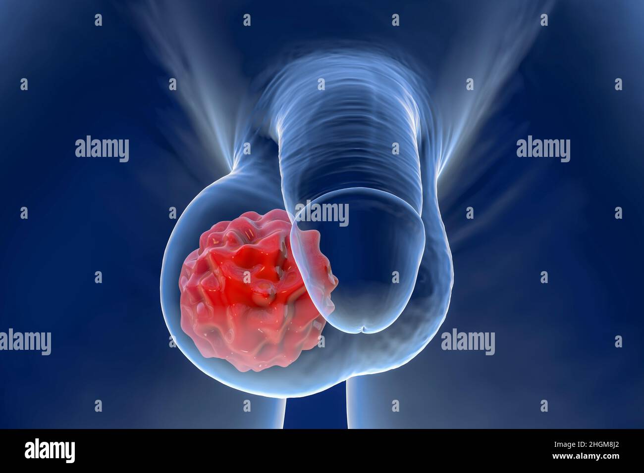 Hodenkrebs, Illustration Stockfoto