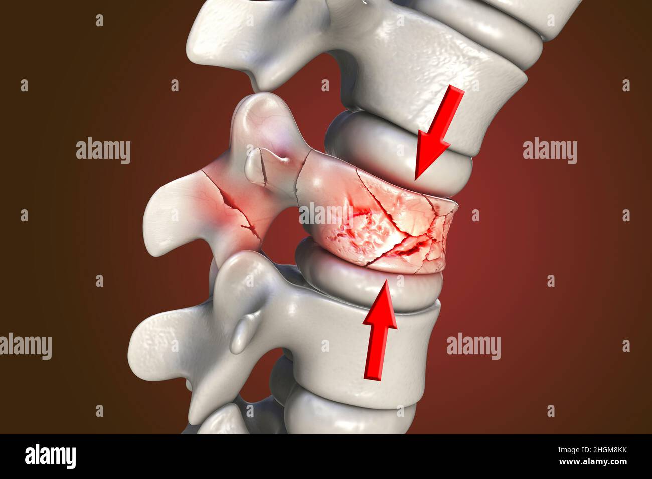 Wirbelsäulenkompressionsfraktur, Abbildung Stockfoto
