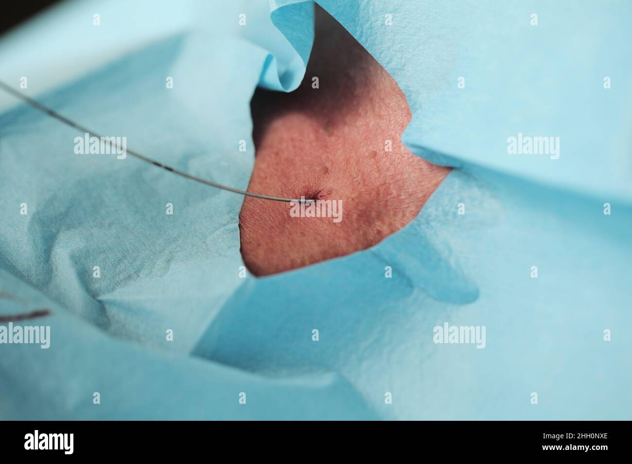 Prozess der Katheterisierung eines großen Blutgefäßes im Krankenhaus. Stockfoto