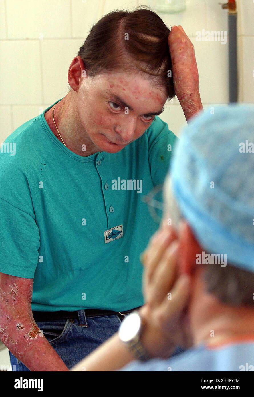 Epidermolysis Bullosa Dystrophica -Fotos Und -Bildmaterial In Hoher Auflsung Alamy