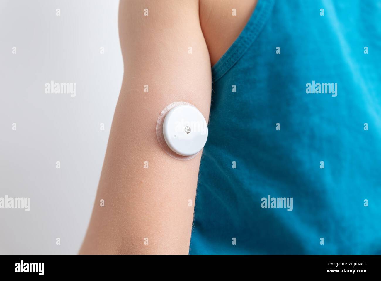 Blutzuckersensor am Arm eines Kindes. Sensor zur Fernmessung des Blutzuckerspiegels mithilfe der NFC-Technologie auf einem Mobiltelefon oder Lesegerät Stockfoto