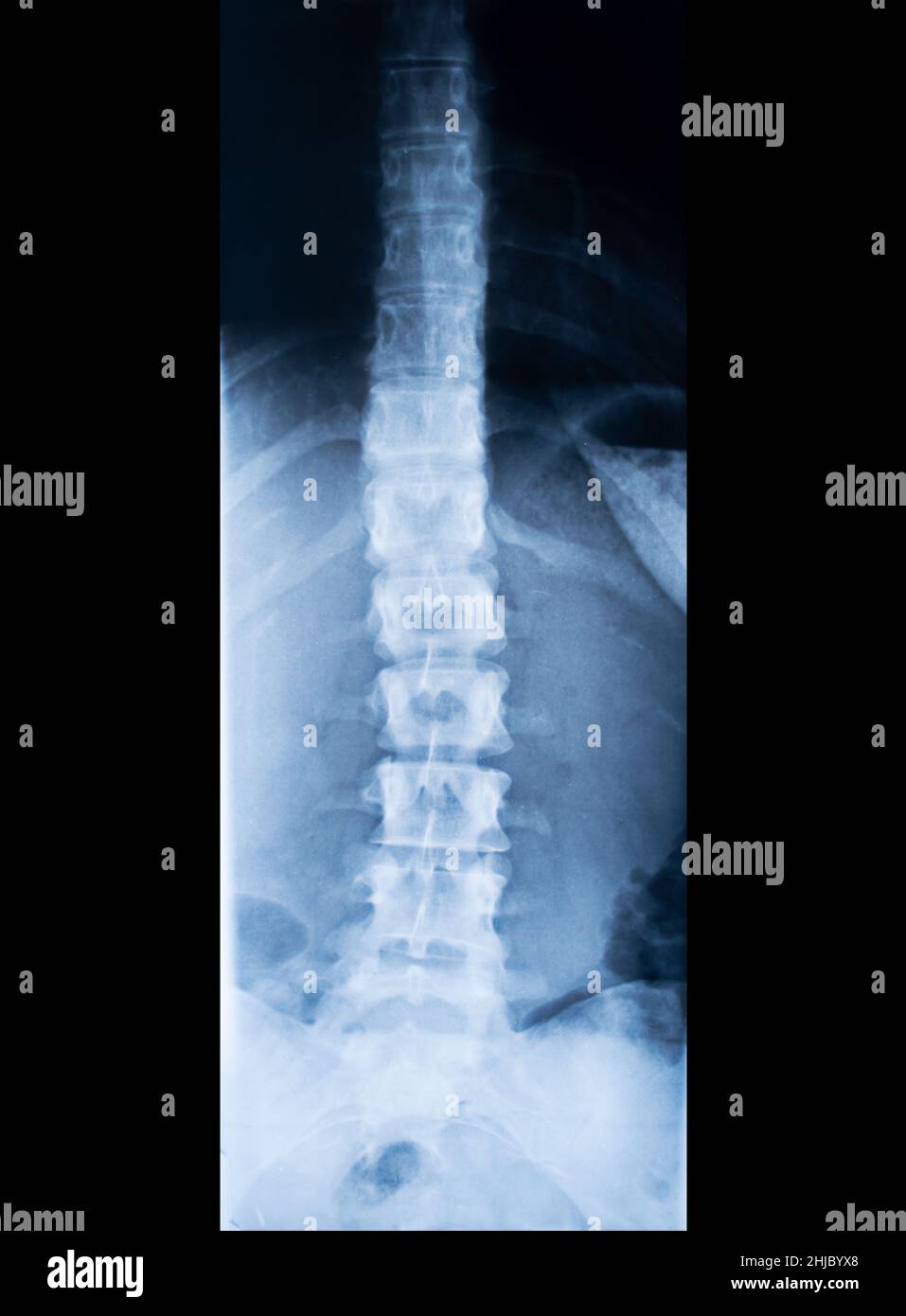 Röntgenaufnahme der menschlichen Wirbelsäule, isoliert auf Schwarz Stockfoto