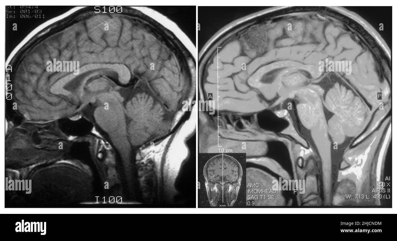 Auf der linken Seite befindet sich eine MRT-Untersuchung (sagittale Ansicht) des normalen Gehirns einer 54-jährigen Frau. Rechts befindet sich eine axiale MRT des Gehirns eines 26-jährigen Mannes, dessen Kopf bei einem Autounfall verletzt wurde. Die MRT-Diagnose zeigte eine kleine Arachnoidzyste im parasagittalen vorderen linken Frontalbereich (dunklerer grauer Bereich oben, nach vorne). Alle anderen Aspekte waren normal. Stockfoto