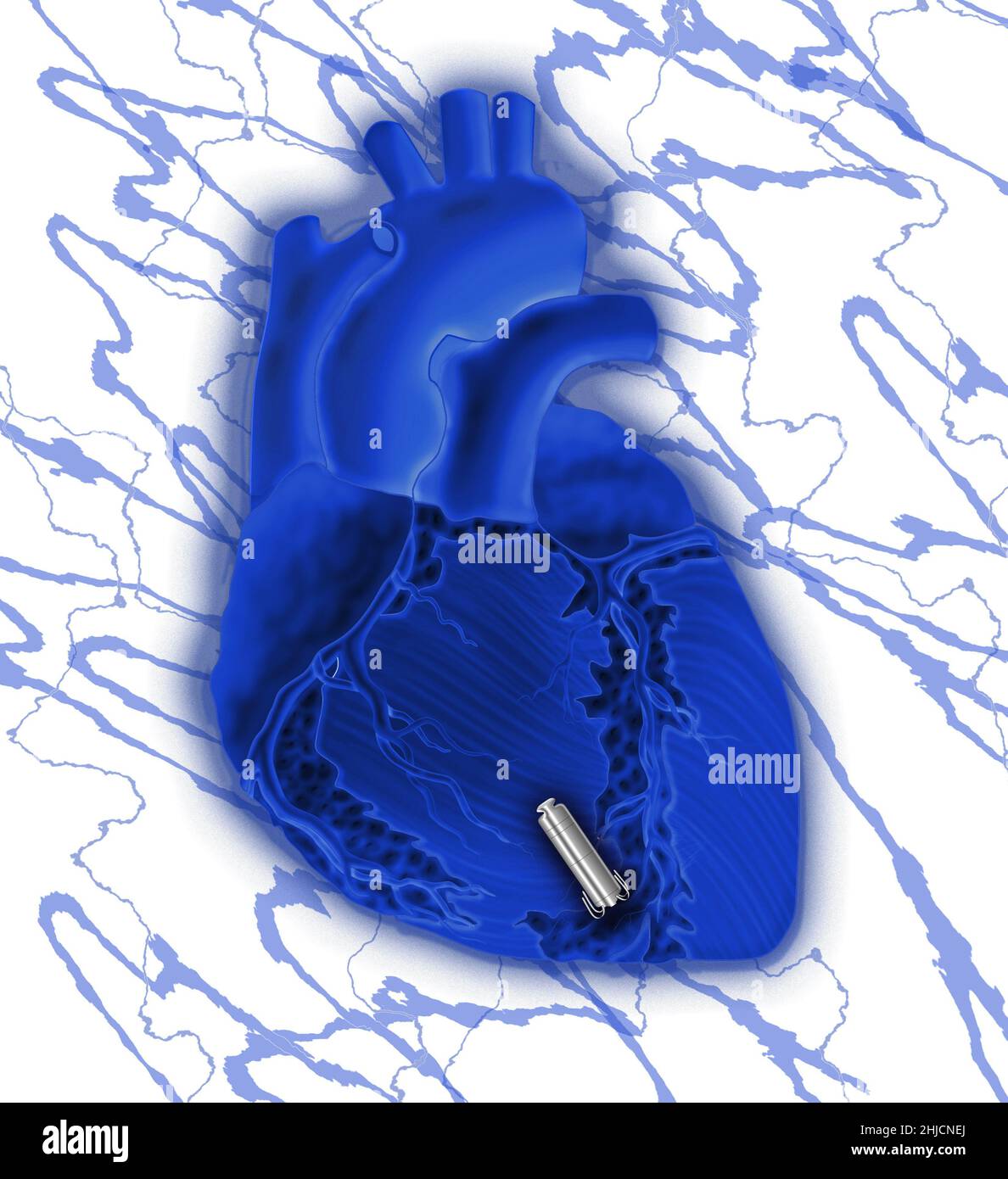 Konzeptuelles Bild eines bleifreien Herzschrittmachers. Es ist viel kleiner als ein traditioneller Herzschrittmacher und hatte auch keine Ableitungen vom Herzschrittmacher zum Herzen. Es wird über eine Beinvene in der rechten Herzkammer in das Herz selbst gelegt. Stockfoto