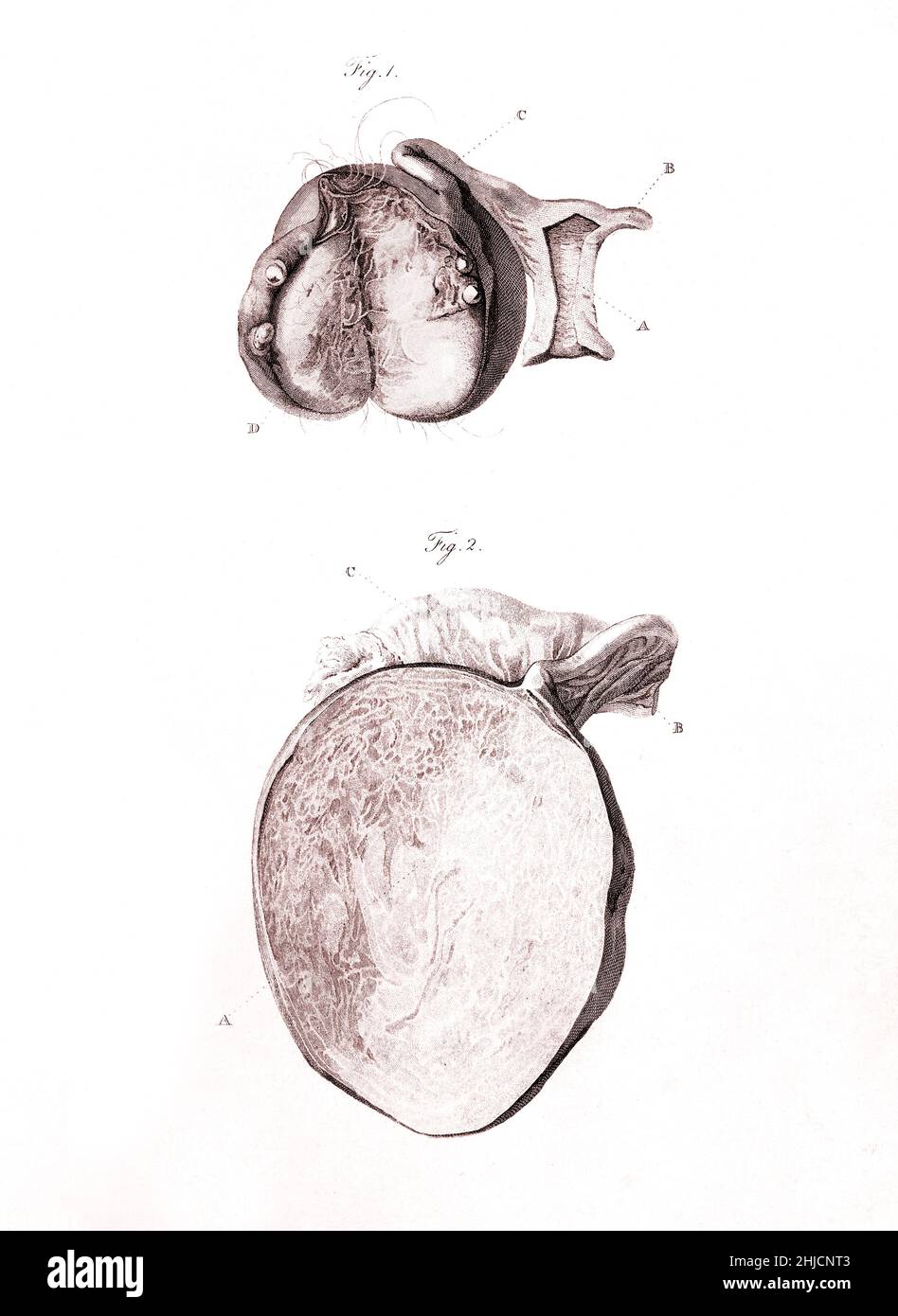 Illustration der Eierstockerkrankung, 1802. „in dieser Platte ist eine sehr ungewöhnliche Veränderung der Struktur in einem Ovarium dargestellt, durch die es in einen membranösen Beutel umgewandelt wird...“ Von J. Heath und Matthew Baillie. Stockfoto
