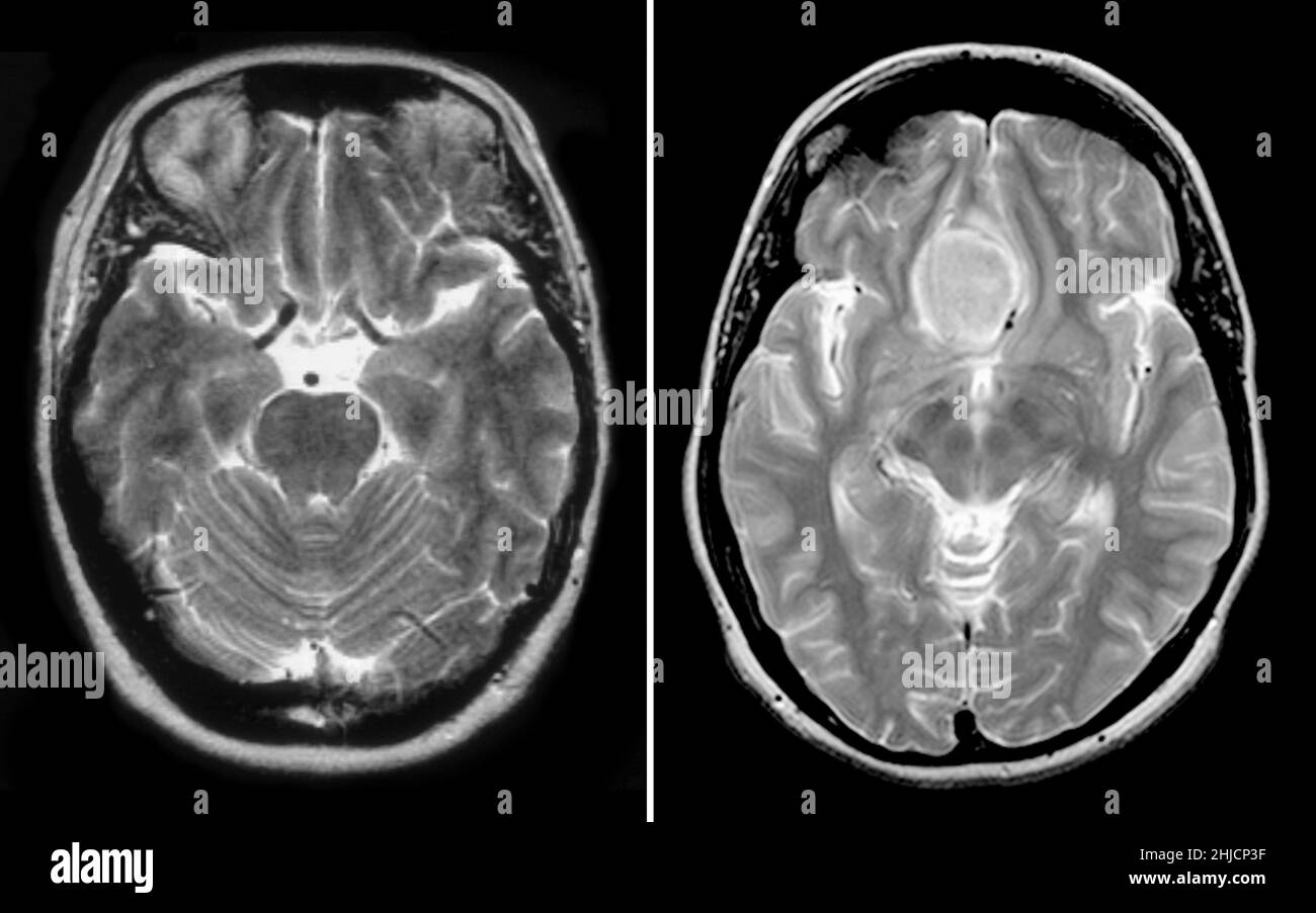 Auf der linken Seite befindet sich eine MRT-Untersuchung (T2-gewichtete, axiale Ansicht) des normalen Gehirns einer 54-jährigen Frau. Rechts ist ein axiales MRT mit dem typischen Auftreten eines olfaktorischen Nut-Meningioms zu sehen. Meningiome sind gutartige Tumoren, die aus der Abdeckung des Gehirns entstehen. Diese haben in der Regel eine gute Prognose. Stockfoto