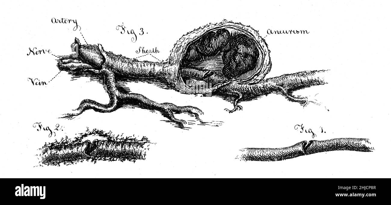Drei Abschnitte einer dissektierten Arterie, beschriftet, mit Aneurysma. Radierung von I. Bell, c. 1815. Stockfoto