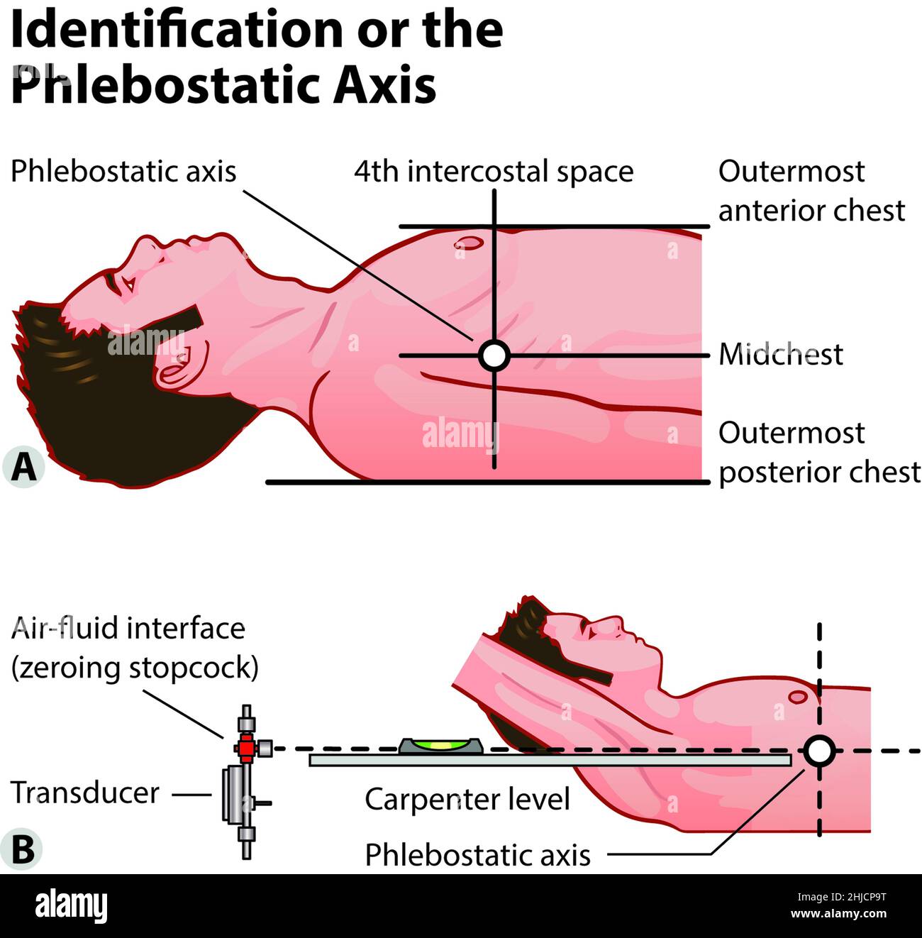 3 von 3 Abbildung eines medizinischen Diagramms, das die intraaortische Ballonpumpentherapie zeigt. Wie man die Pleblostatikachse identifiziert. Pädagogische Biologie Themen Stockfoto