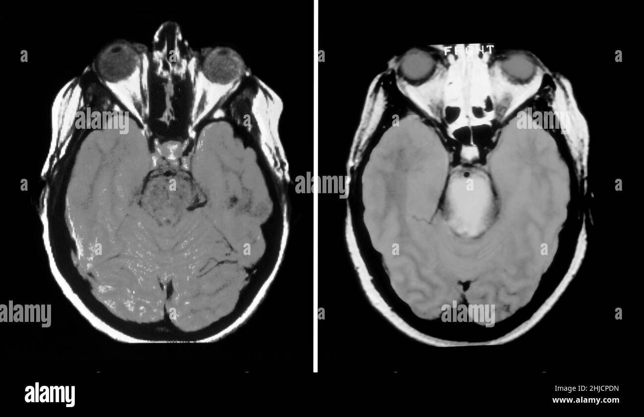 Auf der linken Seite befindet sich eine MRT-Untersuchung (axiale Ansicht) durch das normale Gehirn einer 31-jährigen Frau. Rechts ist ein axiales MRT des Gehirns bei einer Person mit mehreren Hirnnervendefiziten, das eine Vergrößerung des Hirnstamms auf pons-Ebene mit anormaler erhöhter Signalintensität (weißer) zeigt. Dies stellt ein primäres Neoplasma des Hirnstamms dar, das als Gliom, einem Krebsgeschwulst, bezeichnet wird. Stockfoto