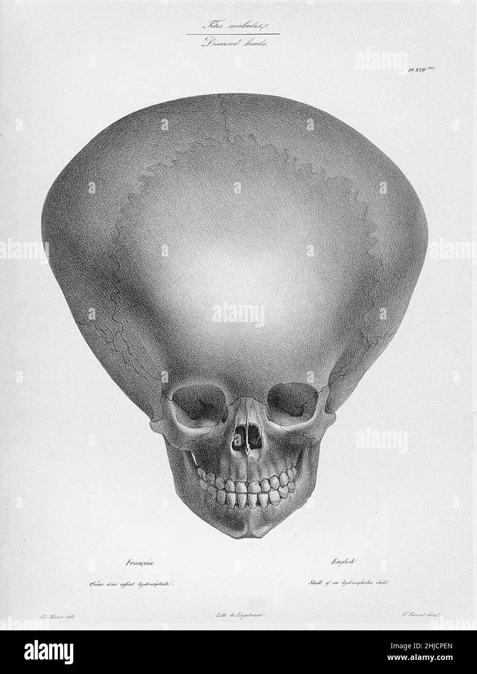 Vimont, Joseph (1795-1857): Lithographie des hydrocepalen Schädels eines Kindes, 1830s. Lithographie von Godefroy Engelmann, (1788-1839). Hydrocepalus ist ein Zustand, in dem es eine Ansammlung von Liquor (CSF) im Gehirn gibt. Stockfoto