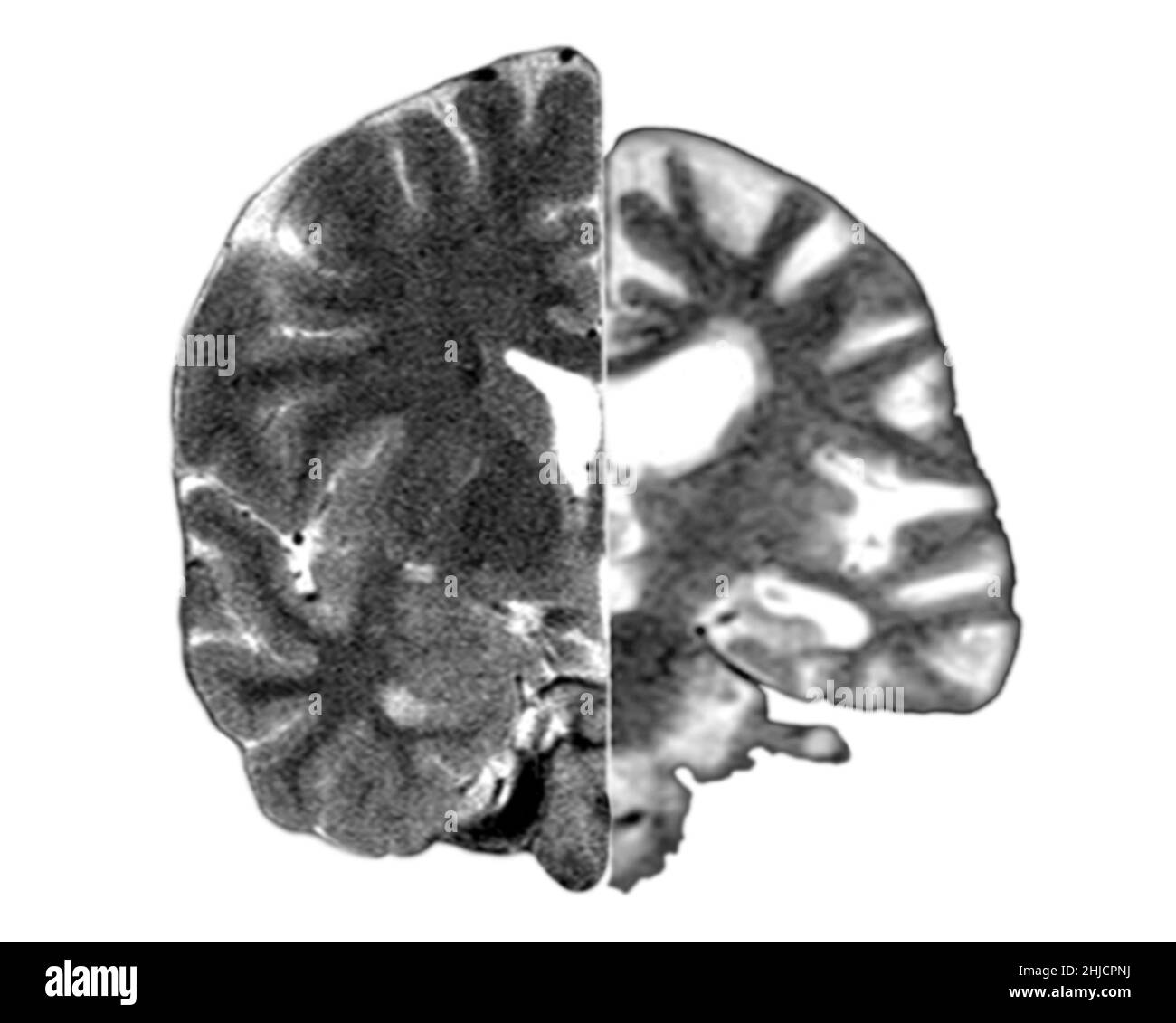 Ein zusammengesetztes Bild, das ein normales koronales (frontales) Querschnitt-MRT-Bild des Gehirns (links) mit einem koronalen MRT-Bild eines Gehirns mit fortgeschrittener Alzheimer-Krankheit (rechts) zeigt. Das erkrankte Gehirn zeigt eine schwere generalisierte Atrophie (Schrumpfung) des Hirngewebes mit einem akzentuierten Gewebeverlust, der die Schläfenlappen einbezieht. Stockfoto