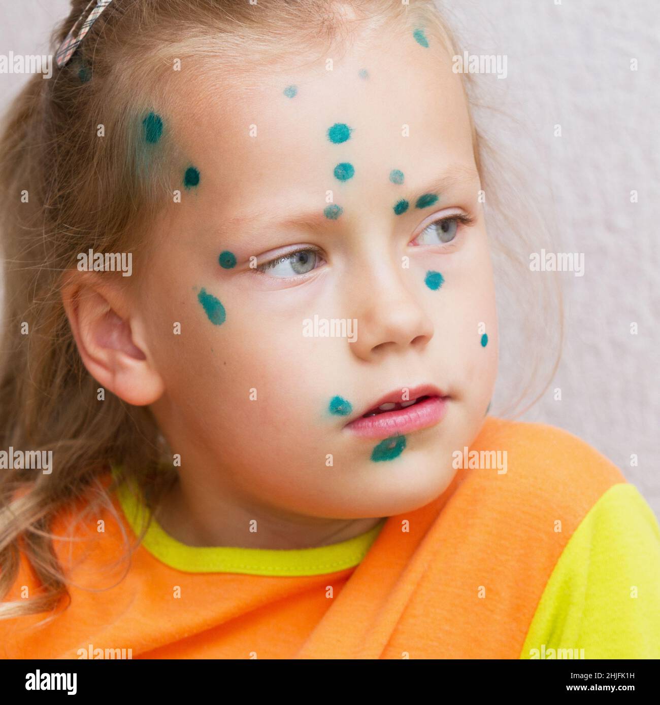 Porträt eines Kindes, das an Windpocken leidet. Stockfoto