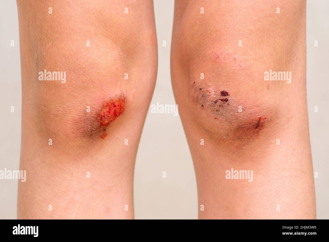 Verletzungen von Kindern. Tiefe Kratzer auf der Haut mit Prellungen auf den Knien des Kindes. Wunden, Kratzer, Abschürfungen am Kinderbein. Stockfoto