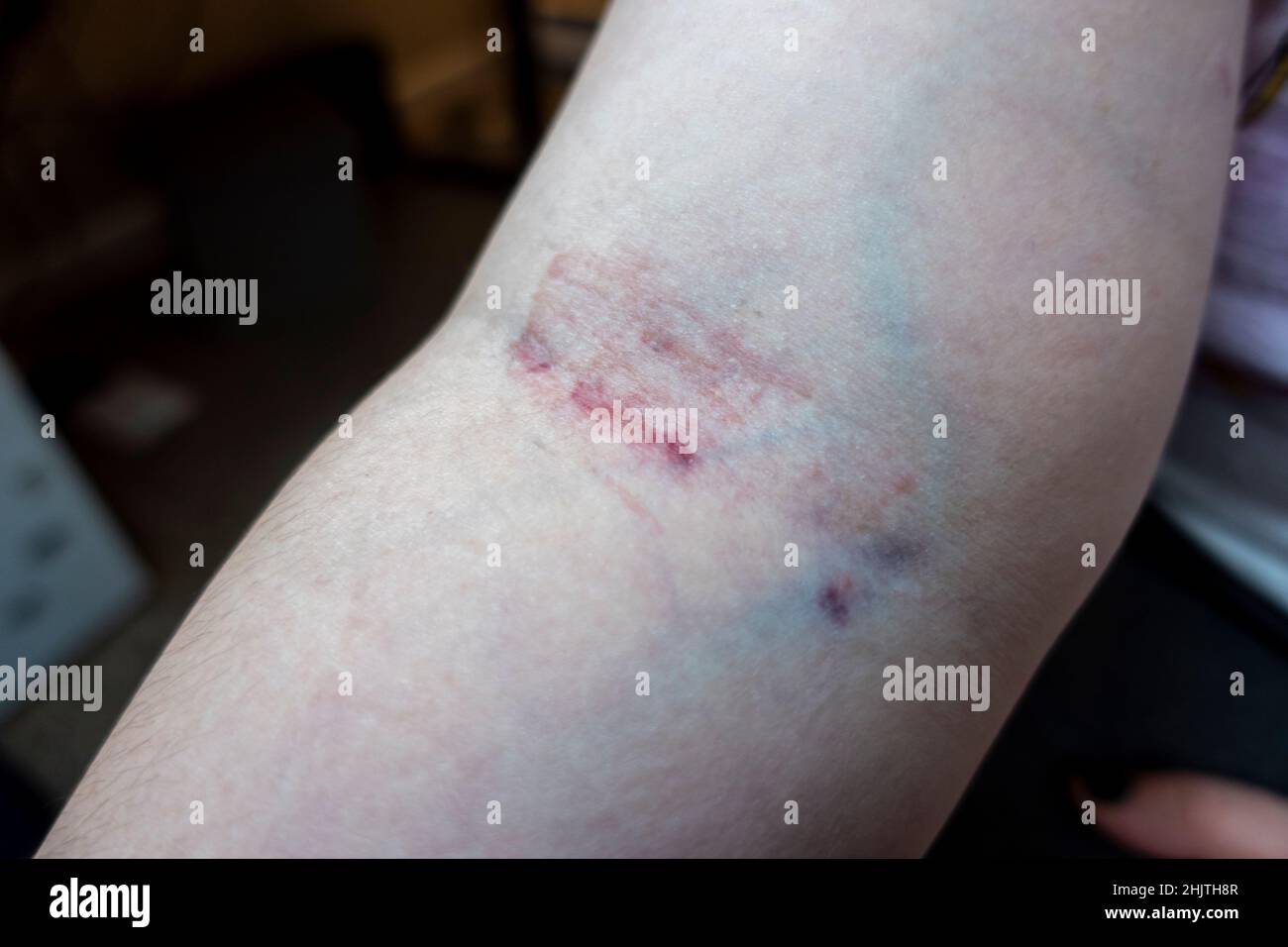 Nahaufnahme des Arms eines kaukasischen Weibchens, nachdem an einem Tag zweimal Blut aus derselben Vene entnommen wurde, was zu schweren Hautreizungen führt Stockfoto