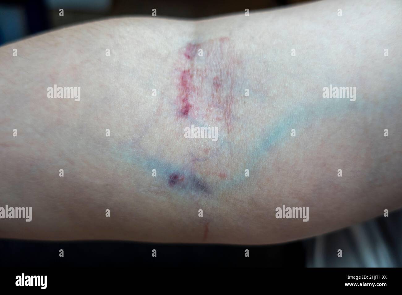 Nahaufnahme des Arms eines kaukasischen Weibchens, nachdem an einem Tag zweimal Blut aus derselben Vene entnommen wurde, was zu schweren Hautreizungen führt Stockfoto