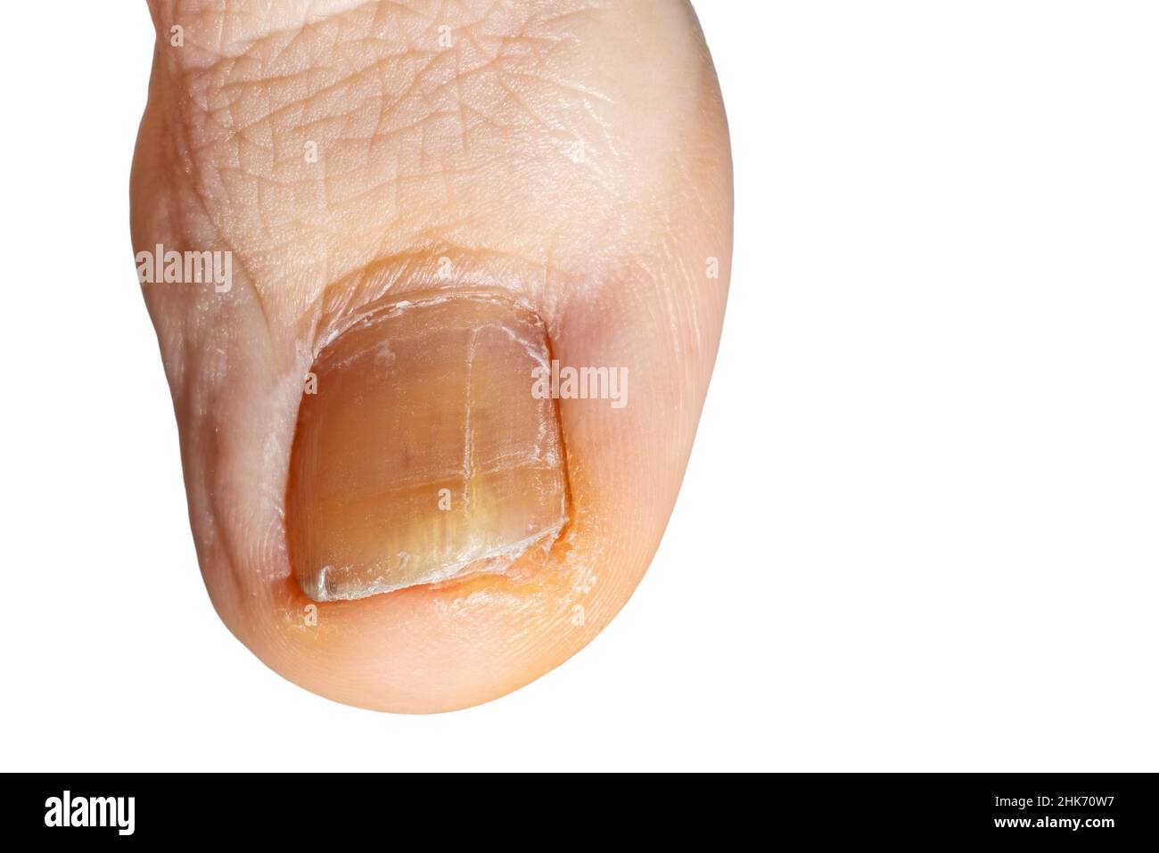 Detail eines Fußnagels mit Pilz. Nahaufnahme der großen Zehe des Fußes mit Pilz auf Nagel isoliert auf weißem Hintergrund Stockfoto