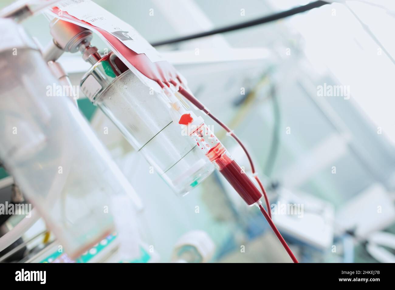 Blutbeutel, der während der Bluttransfusionstherapie in der Intensivstation auf dem Stativ hängt. Stockfoto