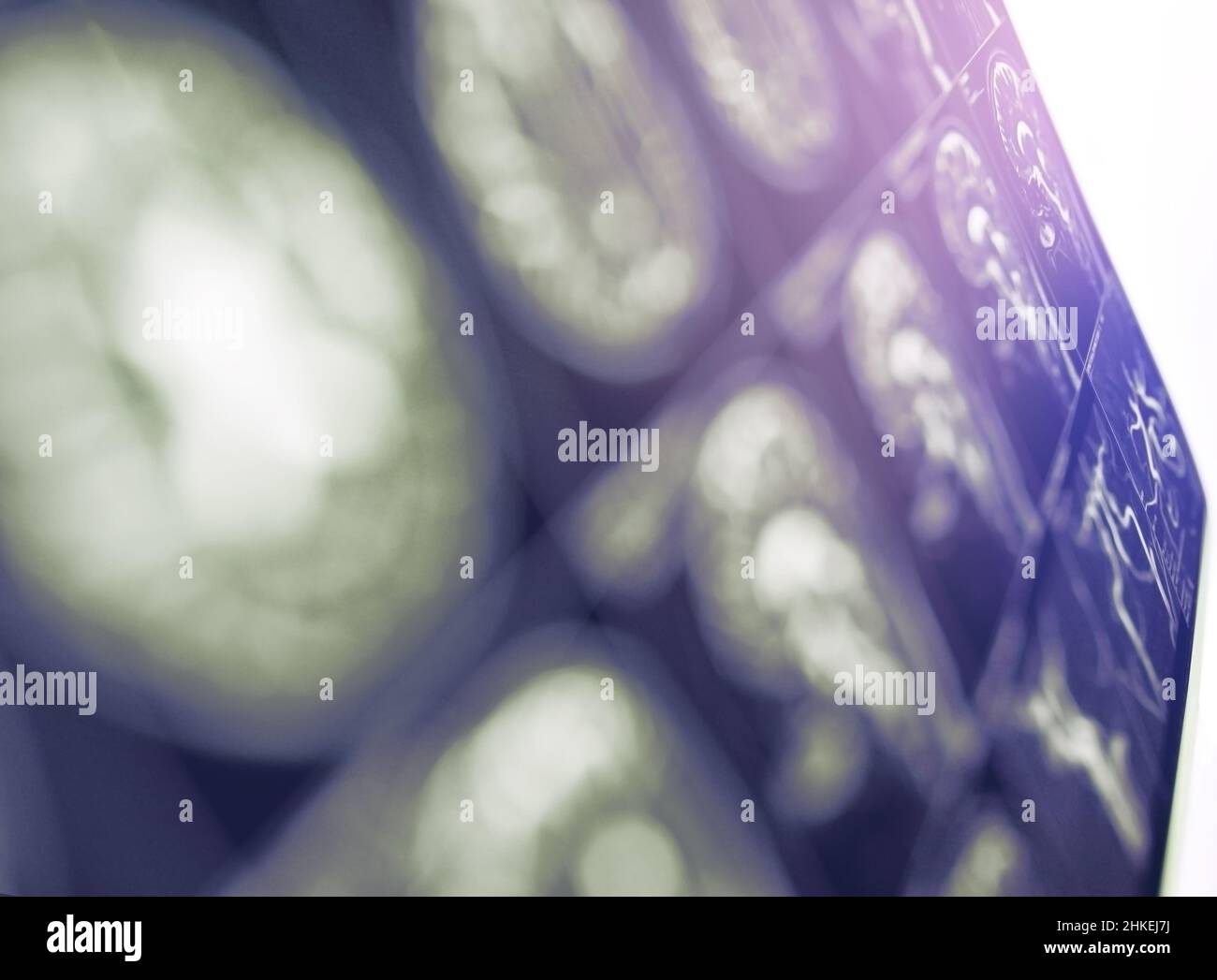 MRT-Bild des Gehirns als unfokussierter medizinischer Hintergrund. Stockfoto